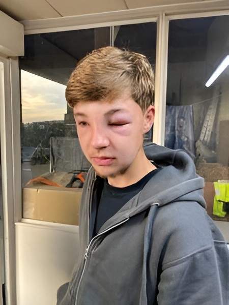 Enfant piqué par une guêpe Rots